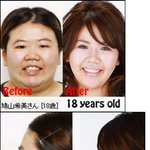 ★★혐오,충격주의★일본인 성형 <b>비포</b> 앤 애프터(사진有)★★