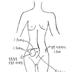 우리 딸이 다쳤어요 (장파열,비장절재,취장절재,간파열,<b>담낭</b>절재)