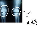 <b>성장판</b> 확인법 사진(有)@@@@@@@@@@@@@@@@@@@@@@...