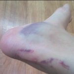 ★☆(멍든사진有)우리학교 일진女가 자꾸 저를 개롭힙니다.ㅠㅠㅠㅠ☆★