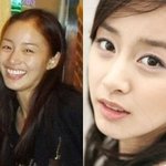 연예인들의  교정, <b>양악</b> 전후 비교