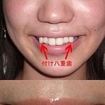 일본에서의 <b>덧니</b> 성형 유행!