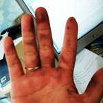 사진 첨부] 고데기가 터져서 손이 시컴해졌어요..