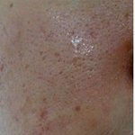 ○나쁜피부 착한피부로의 극뽁 스토리○혐짤주의