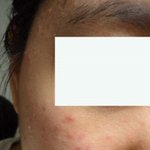 ★여드름 잇는 사람 여기여기 모여라★