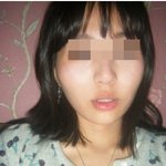 <b>광대</b>수술했는데 잘된건지 좀 봐주세요.ㅠㅠ