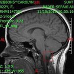 ★★★★★(슬픔)목숨 걸고 웃는 희귀병★★★★★