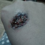 ★★★(사진有) <b>화상</b> 상처 만들기 ★★★