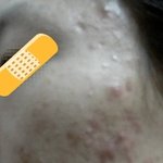 (사진有) 성인여드름.....2달후