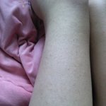 언니들 다리에 나있는 오돌톨한 빨간 두드러기? 이거 피부과가면없앨수있어...