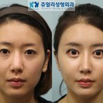 (성형<b>전후</b> 퍼옴) 구경하기.