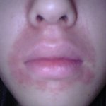 입<b>주위</b>가 빨개요 ㅜㅜ(사진有)