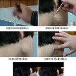 [화제] 여드름 / 뾰루지에 희소식!!