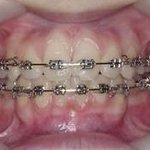 ★★★★★치아교정하는 사람들에 대한 생각을 알고싶습니다★★★★★