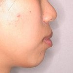 ★양악수술★ 양악수술에 관한 불편한 진실