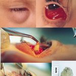 ★★★★★★ 렌즈의 위험성!!!!초강력혐오주의!!!★★★★★★