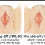 ★★★<b>소음순</b> 비대증 수술해본 사람 있어?★★★