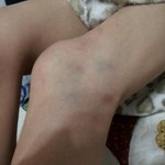 결혼두<b>달차</b> 남편의폭력 .(사진첨부)