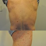 마음의 병까지 생기는 <b>건선</b>.........ㅠㅠ