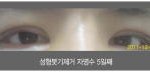 ★★★★★사진有<b>쌍수</b>부작용...심각함...★★★★★★★