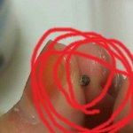 ◇◆[사진이요기잉네]  여드름짠 볼에서 돌이 나왔어요ㅋㅋㅋㅋㅋㅋㅋ◆◇