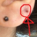 수정★★★혐오사진有★귀걸이가귓불에박혔어요ㅠㅠ★★