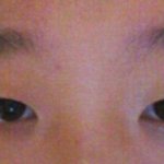 [사진有]저는 쌍수를 해야할까요