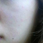 임신중에 트러블 관리.. 어떻게 하세요?ㅠㅠ