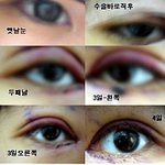ㅠㅠ저..쌍수+앞트임재수술할까요?말까요? 혐오有