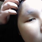 ☆(혐오)(사진有) 내 얼굴에 일어난 대참사☆★☆★