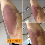 저희 엄마 손가락좀 봐주세요 !!!!ㅠㅠ