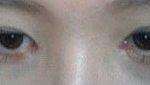 청주s성형외과에서 성형 후 망한 눈..저 어떡해요 진짜 분통터짐