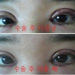 ★★사진有有★★<b>쌍수</b>한지 이틀됨, 좀 봐줘봐ㅜㅜㅜㅜㅜ★★