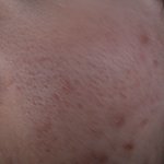 한창 피부좋을나이에 내피부눈감아ㅠㅠ(사진有) 혐오ㅋ..?