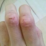 평생 내 친구. 아토피. (주변에 아토피 환자가 있으신 분 꼭 봐주세요)