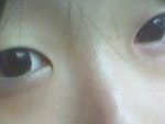 쌍커풀수술