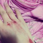 손에 상처난사진有) 맞았습니다...