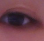 도와주세요 쌍수부작용,...<b>의료</b>사고?