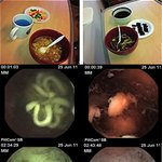 (※혐오주의!!!임산부x 노약자x)<b>뱃속</b>에들어간 라면,,,,,