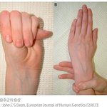 사진 有) 마판증후군을 아시나요?