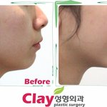 [성형이야기] 턱이 없다고 고민하는 당신을 위해...