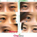 [성형이야기] <b>지방이식</b>으로 애교살도 만들 수 있다고요???