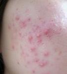 사진有)이런여드름본적있나여(혐오주의)