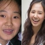 안면,<b>치아</b> 교정 전후 연예인 외모 비교