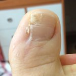 내향성 <b>발톱</b>을 수술했는데요ㅠㅠ...