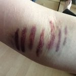 헌혈하다가 팔에 <b>스키드</b>마크 생긴 사연ㅋㅋㅋ