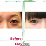 다크서클 없애는 확실한 방법, 눈<b>밑</b> 지방재배치와 눈<b>밑</b> 지방이식!!!