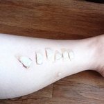 피부과에서 <b>화상</b>입었어요(사진有)