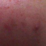 후기/사진有/혐오)여드름 쩌는 얼굴 <b>치료법</b>&amp;여드름 일화★★★★★★★★★★