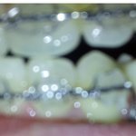 치아교정 부작용? 도와주세요 ㅠㅠ(혐오주의)